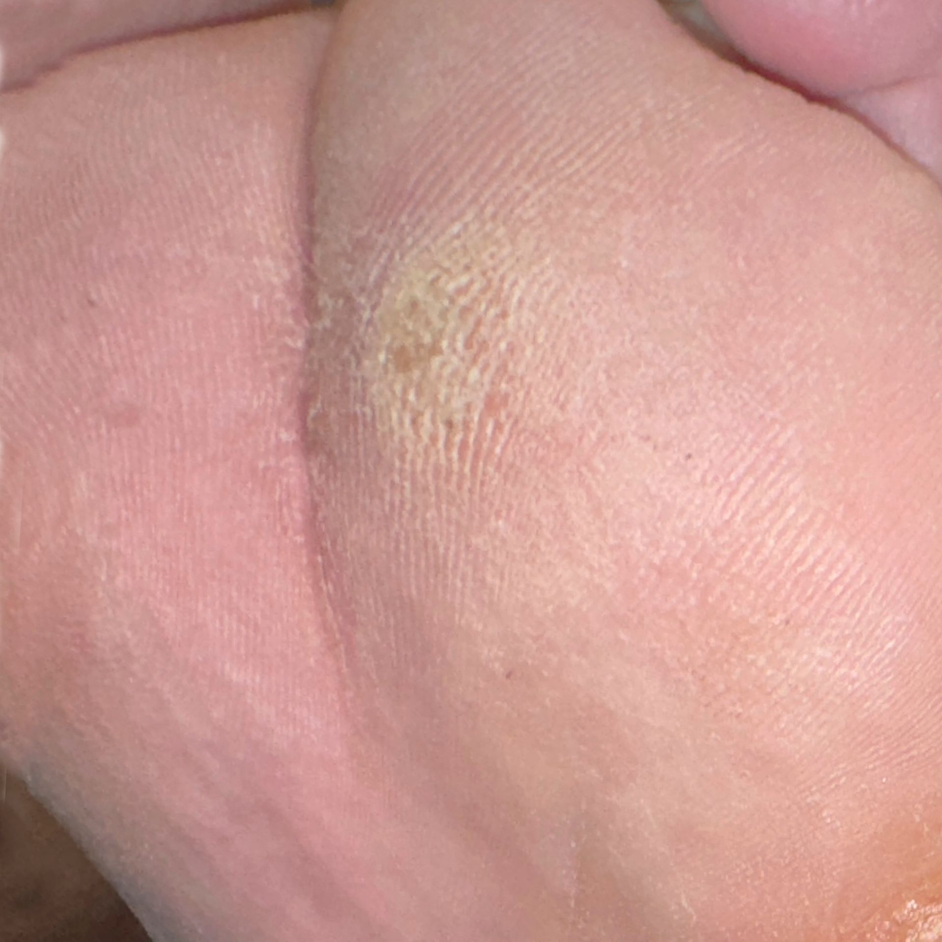 Wound Care for 2nd Toe Bottom of Foot Wound - After