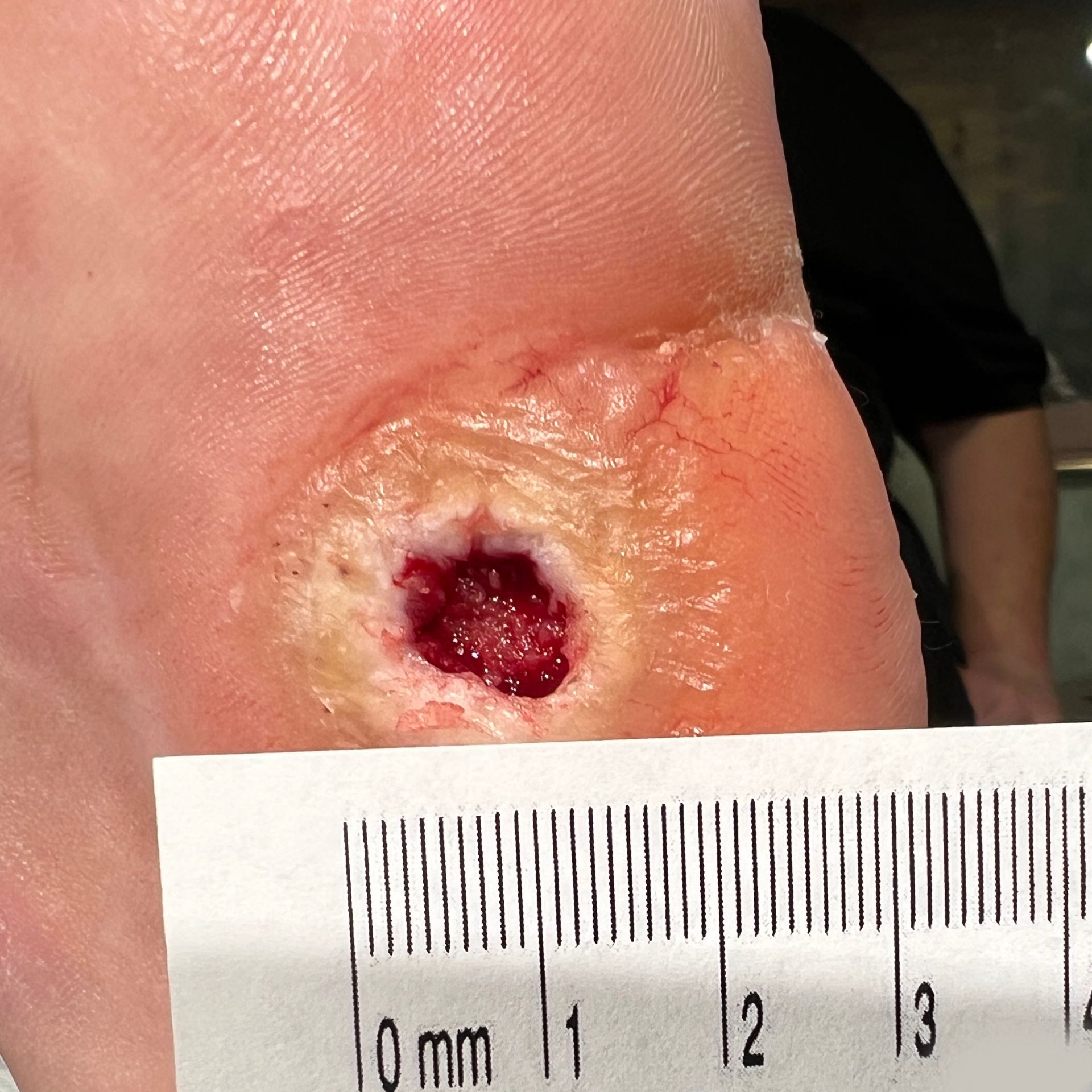 Wound Care for Hole in Bottom of Foot Wound - Before