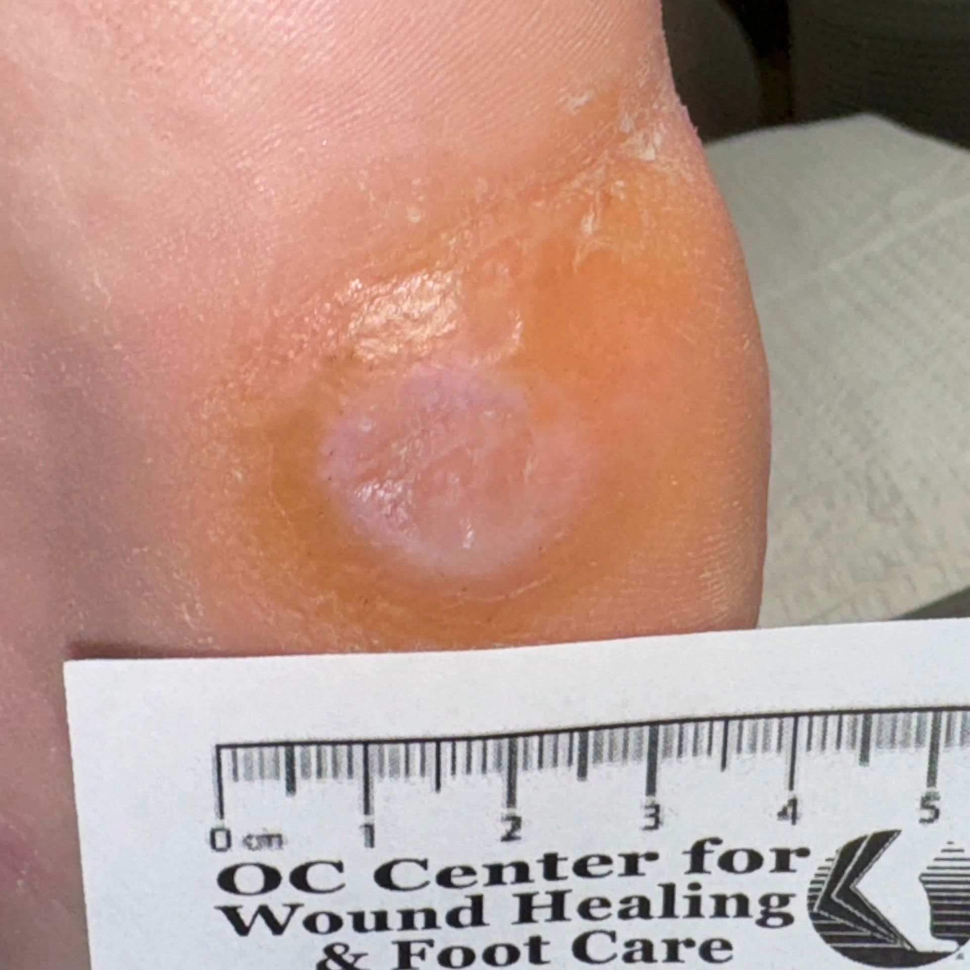 Wound Care for Hole in Bottom of Foot Wound - After