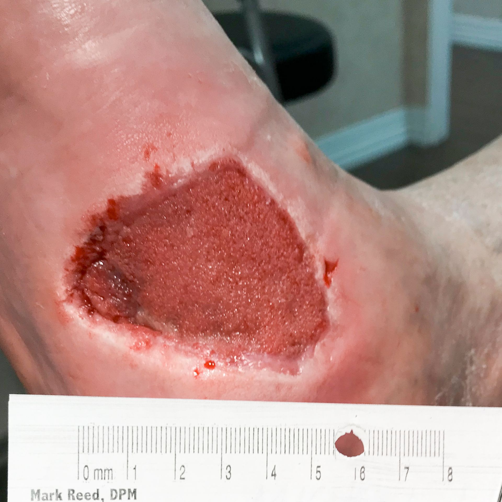 Wound Care for 6 x 5 cm Arch of Foot Wound - Before