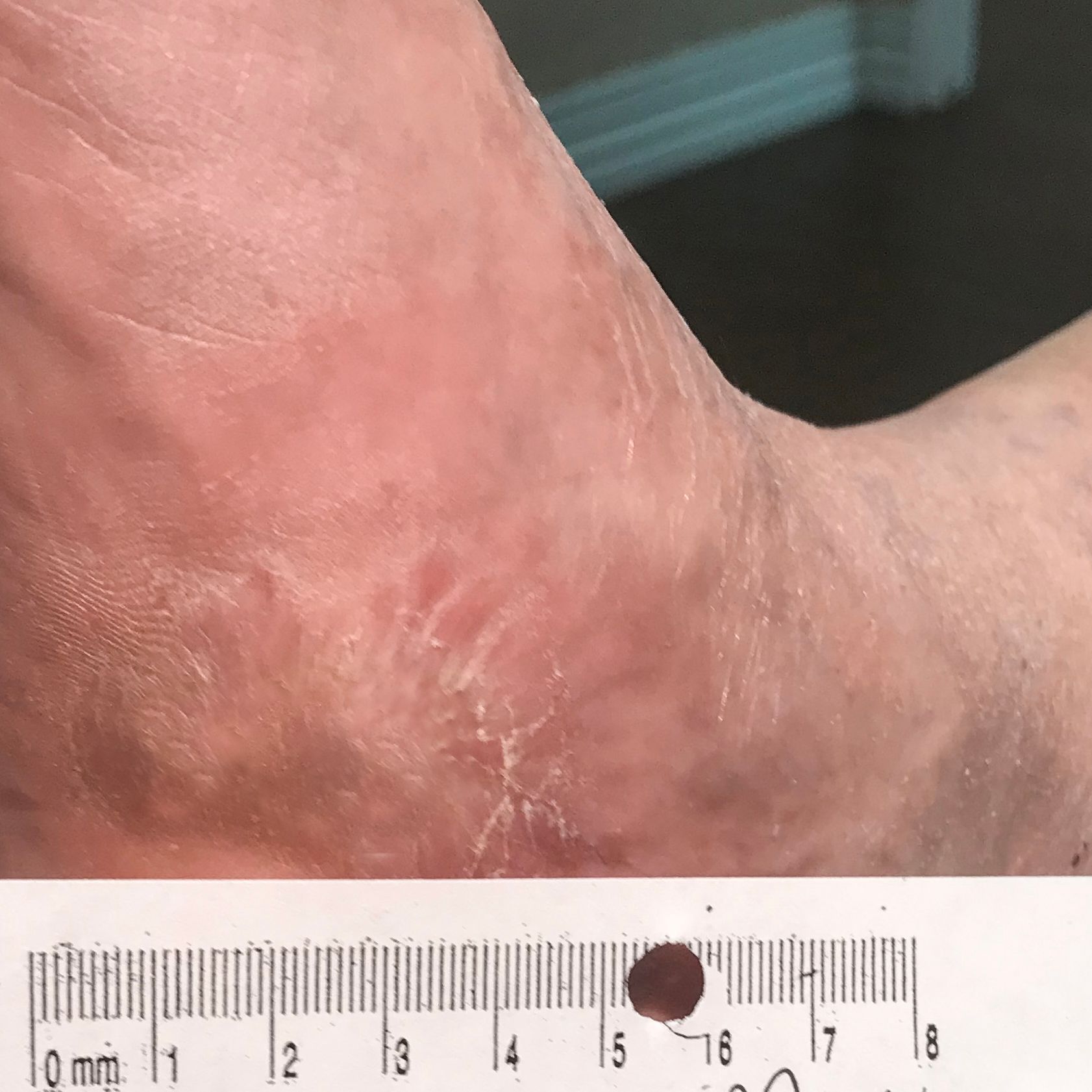 Wound Care for 6 x 5 cm Arch of Foot Wound - After