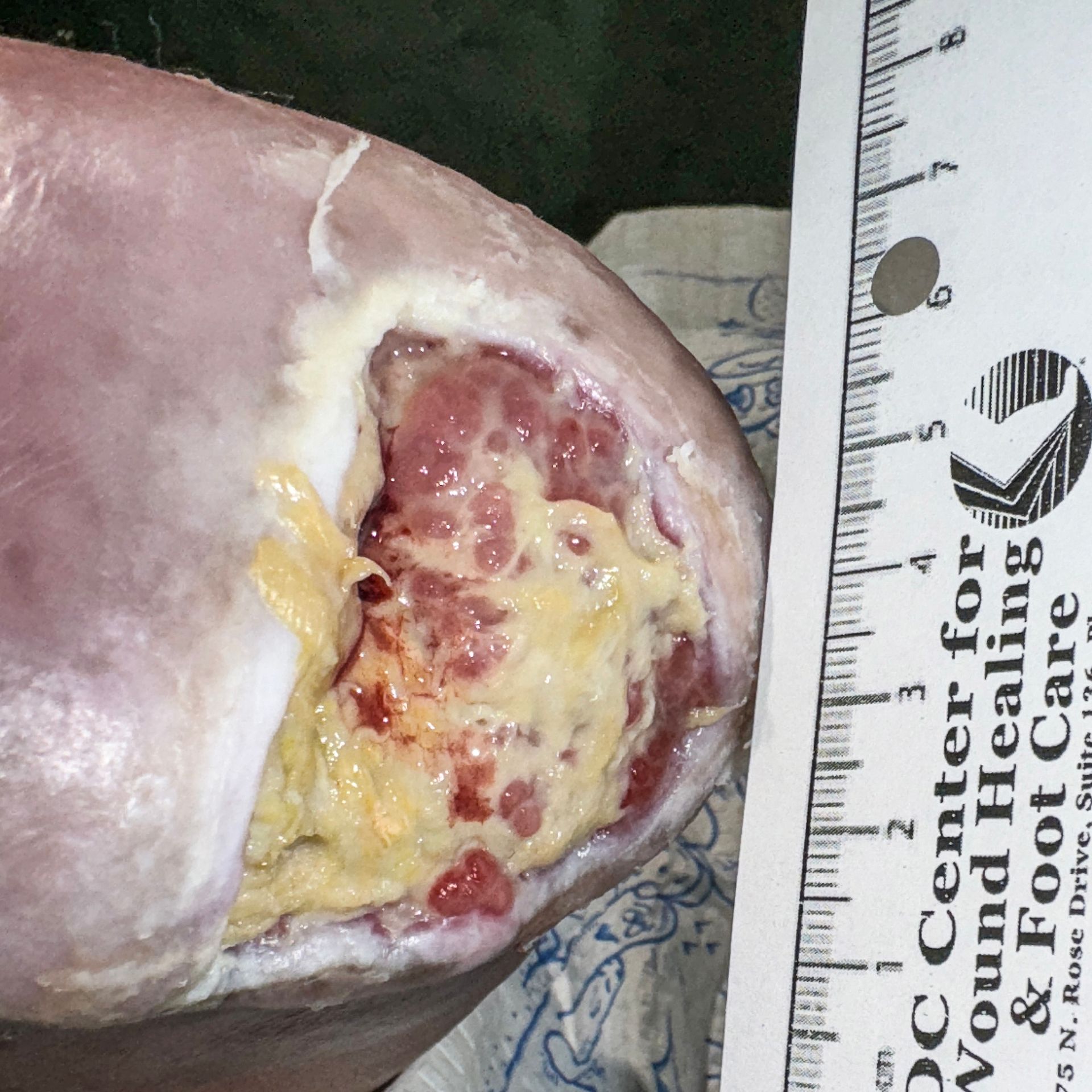 Wound Care for 6 x 5 cm Significant Heel Wound - Before