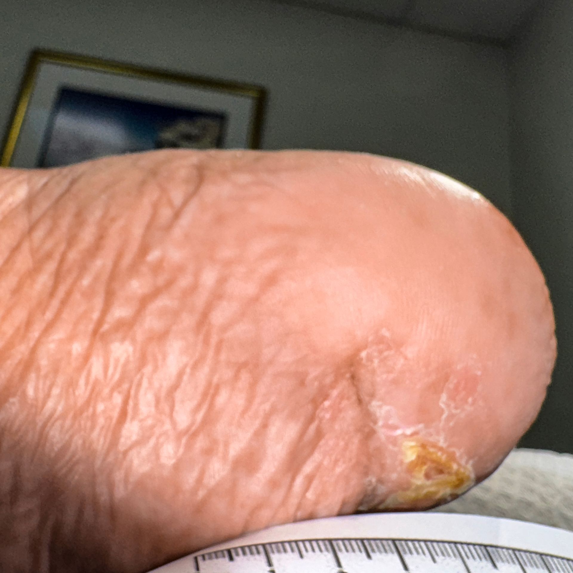 Wound Care for 6 x 5 cm Significant Heel Wound - After