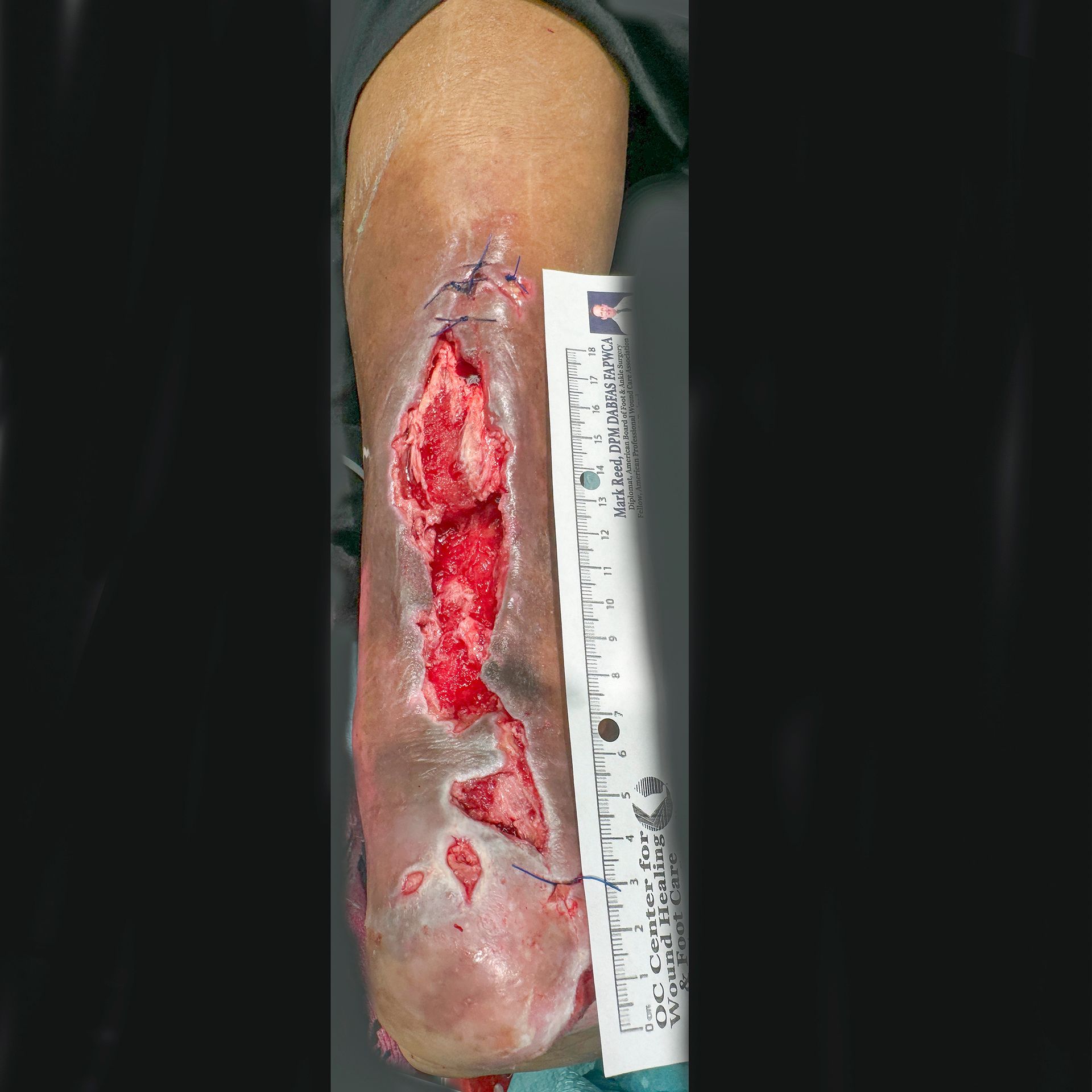 Wound Care for 15 x 6 cm Significant Calf Wound - Before