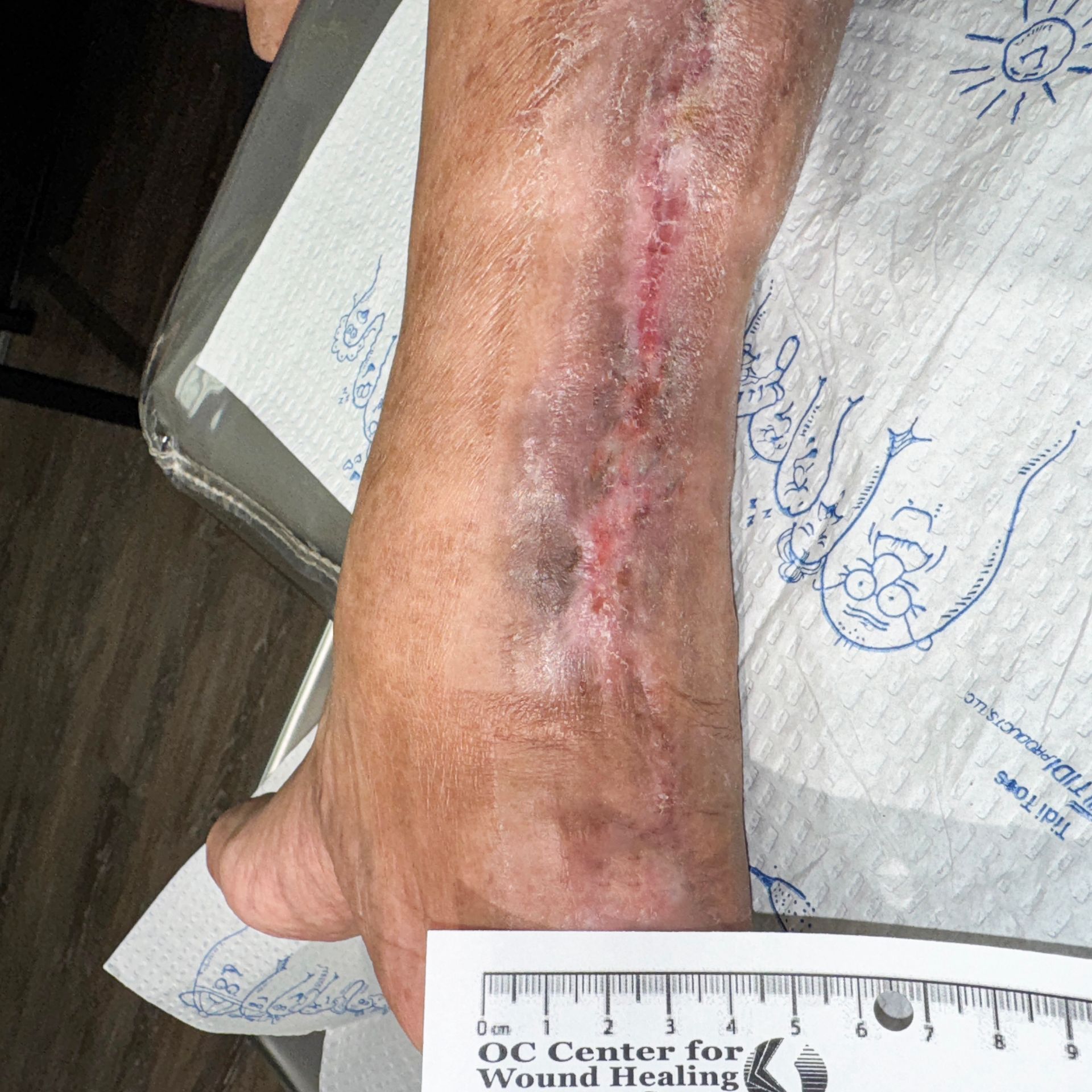 Wound Care for 15 x 6 cm Significant Calf Wound - After
