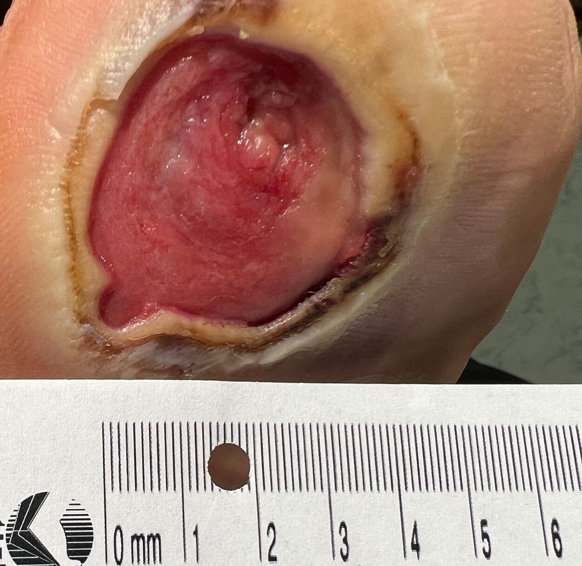 Wound Care for 4 x 7 mm Side of Leg Wound - Before