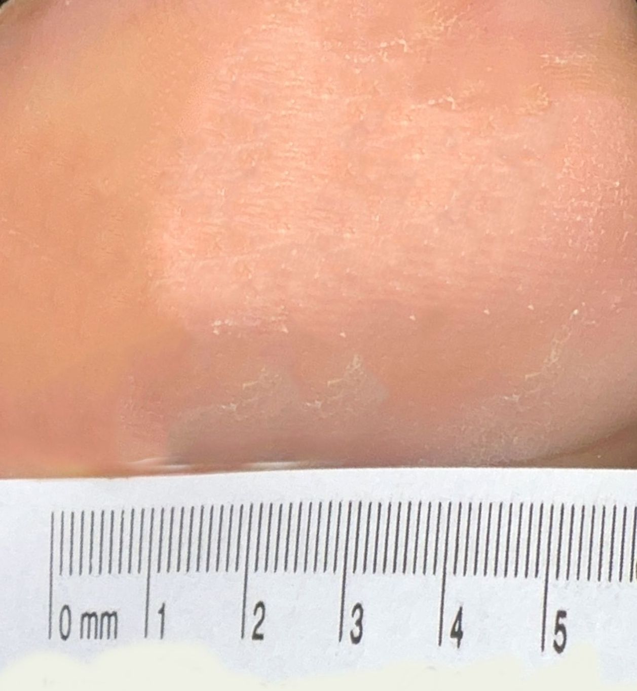 Wound Care for 4 x 7 mm Side of Leg Wound - After