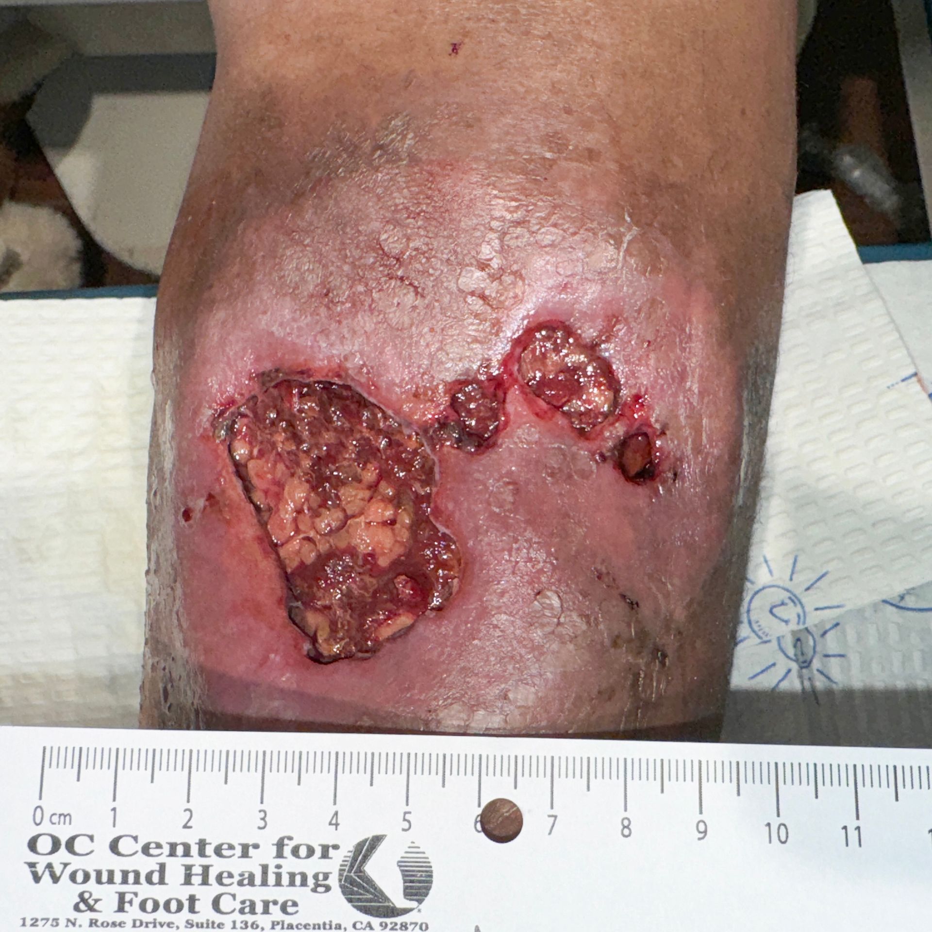 Wound Care for 7 x 5 cm Calf Wound - Before