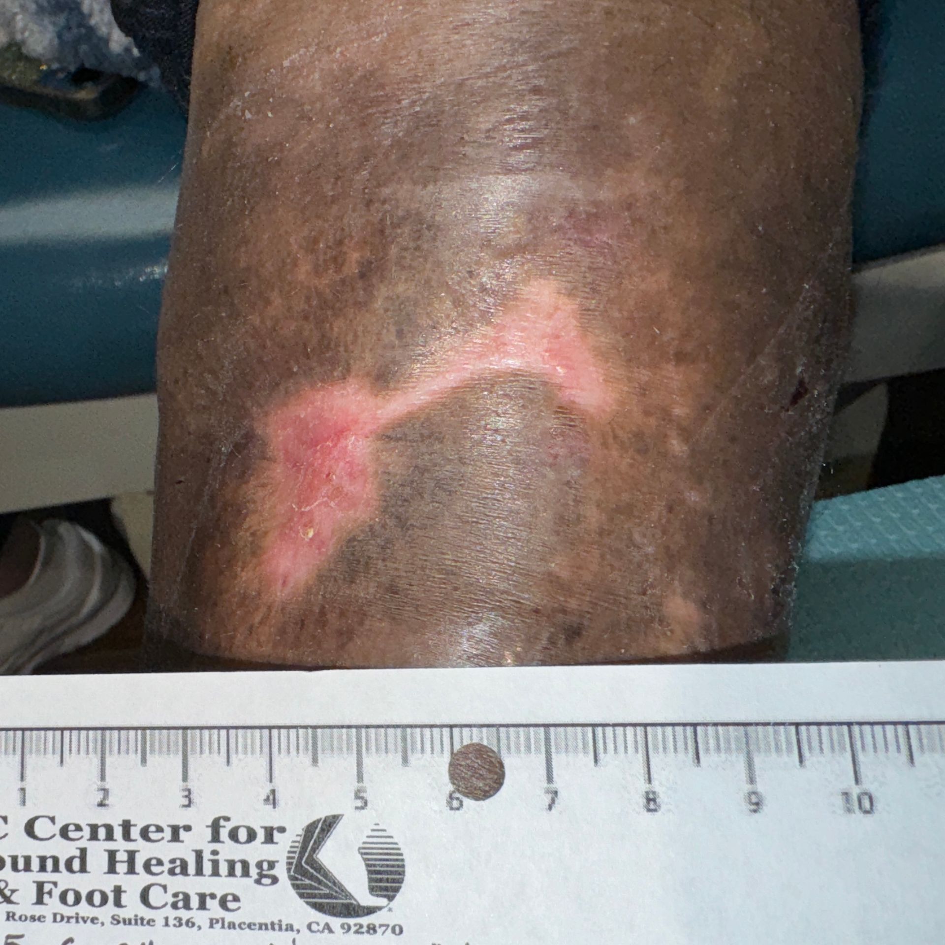 Wound Care for 7 x 5 cm Calf Wound - After
