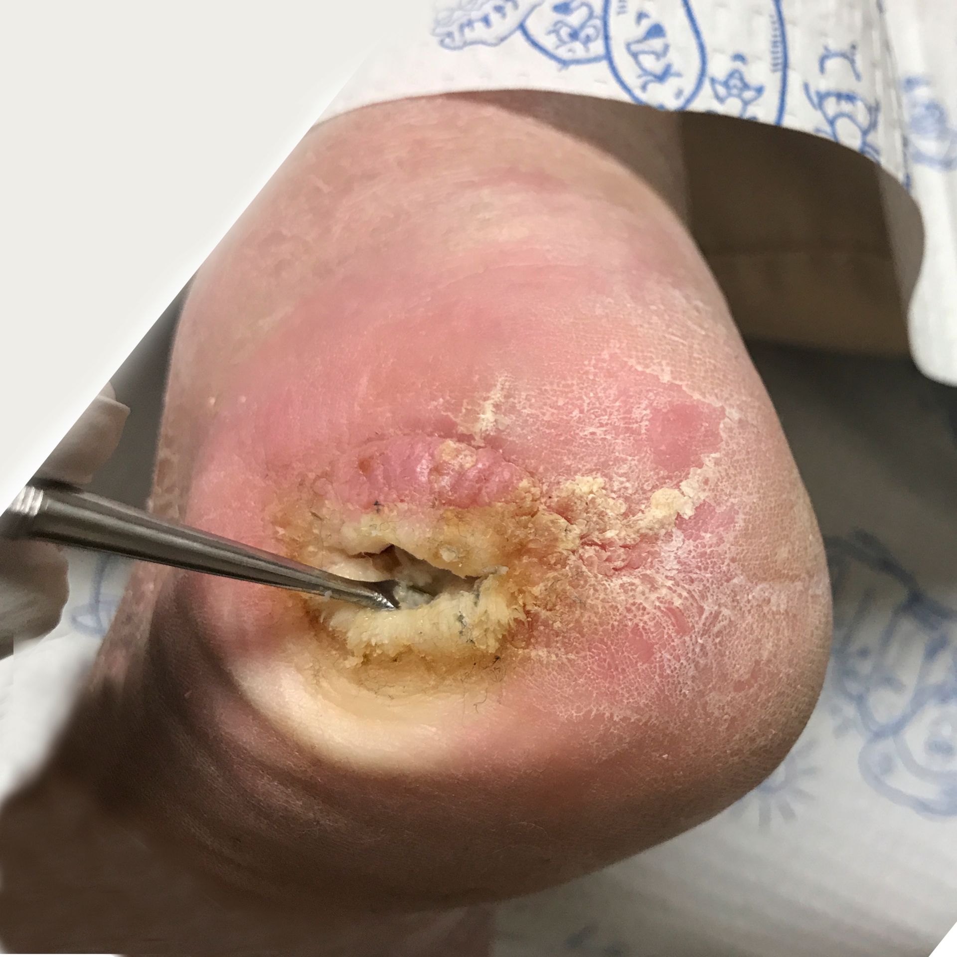 Wound Care for Significant Deep Hole in Heel Wound - Before