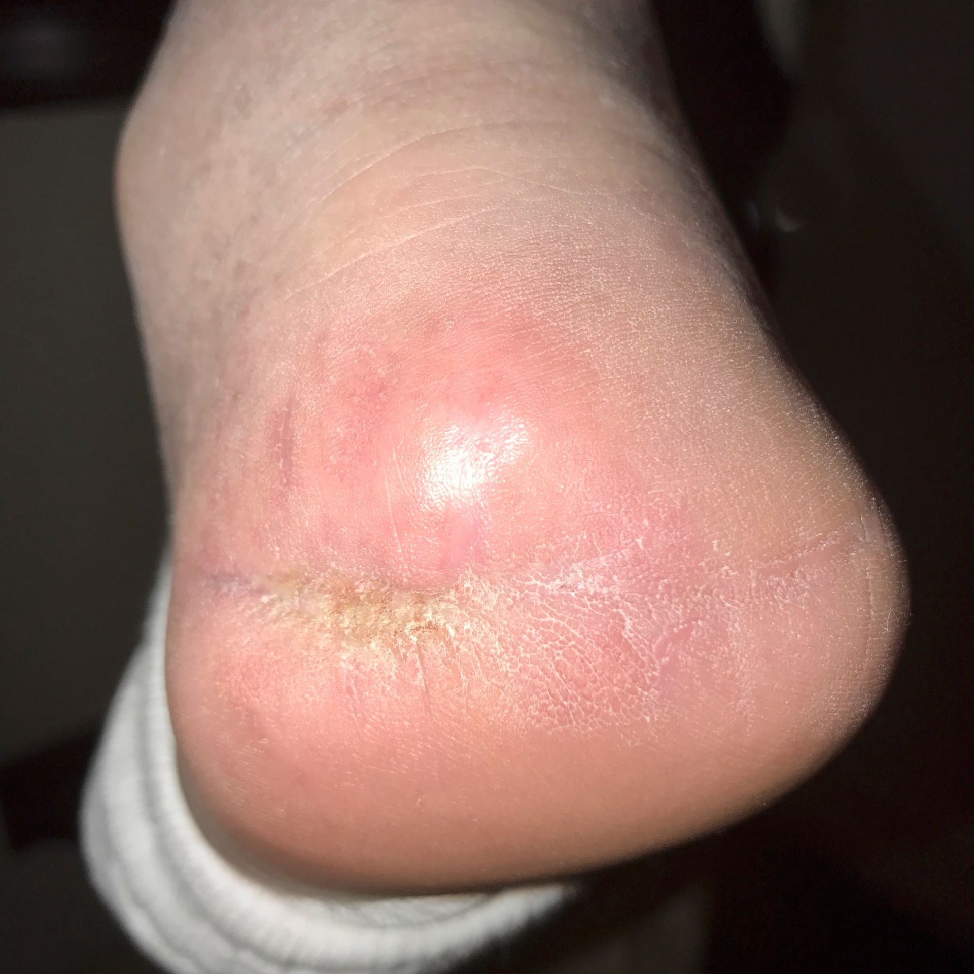 Wound Care for Significant Deep Hole in Heel Wound - After