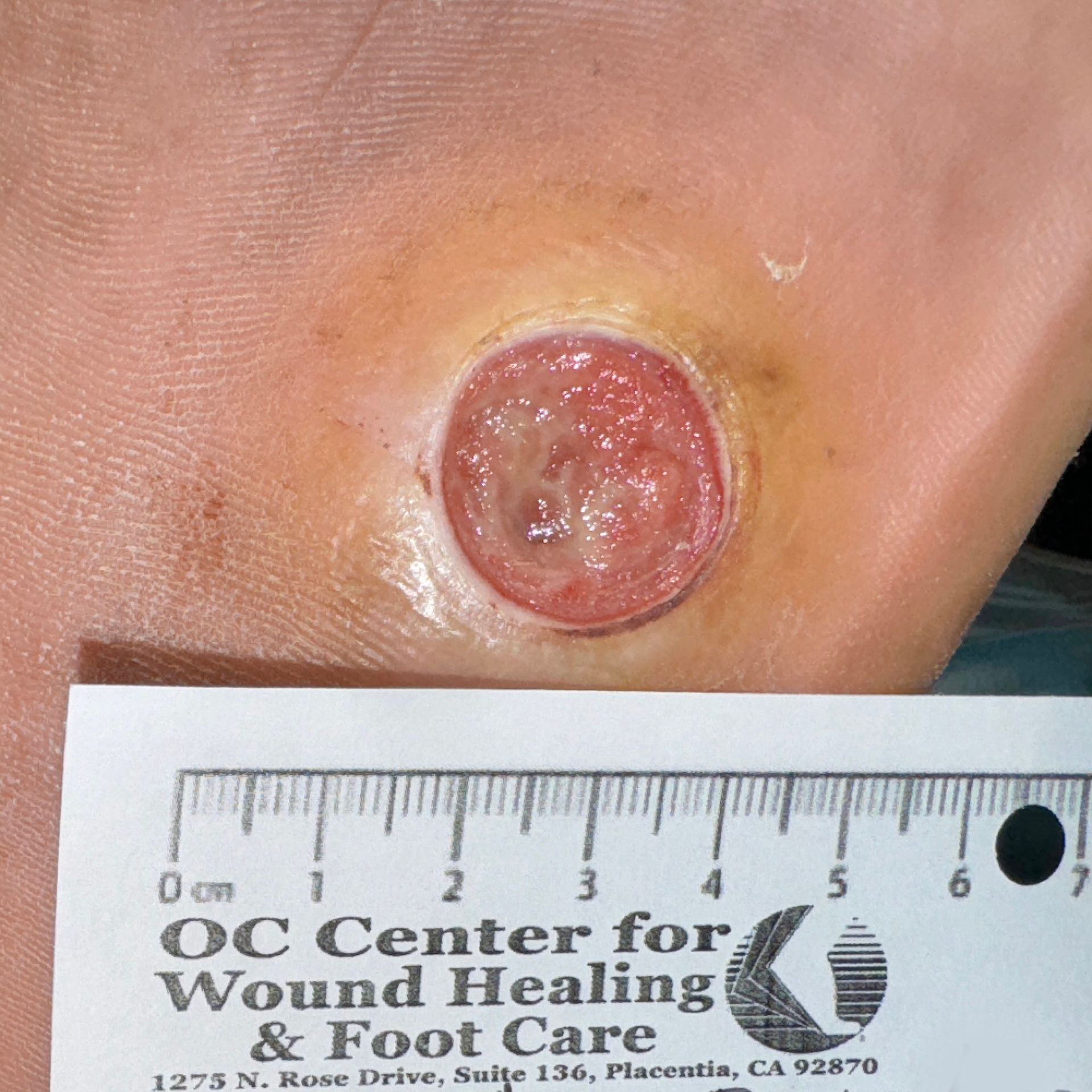 Wound Care for 4 x 7 mm Side of Leg Wound - Before
