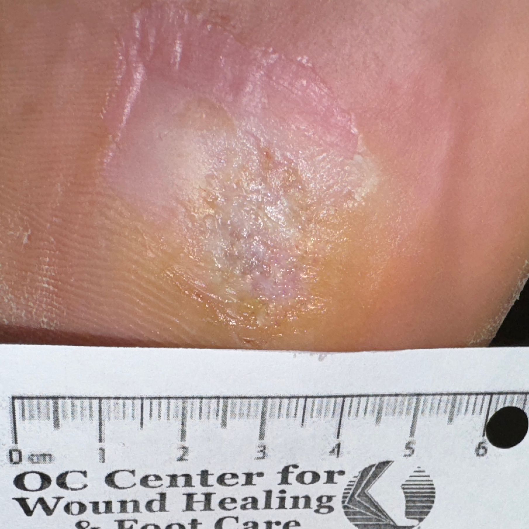 Wound Care for 4 x 7 mm Side of Leg Wound - After