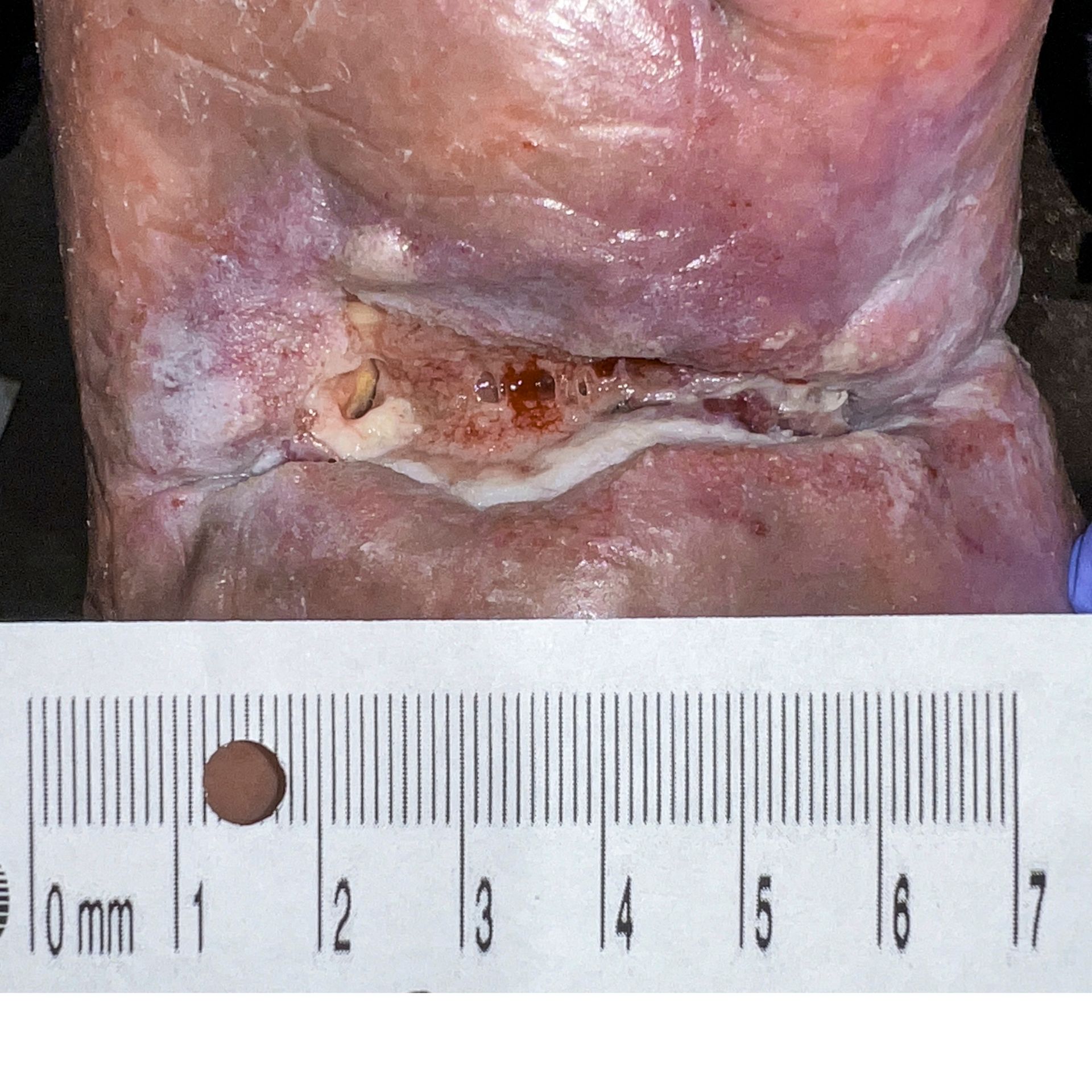 Wound Care for 3 x 3 mm Top of Leg Wound - Before