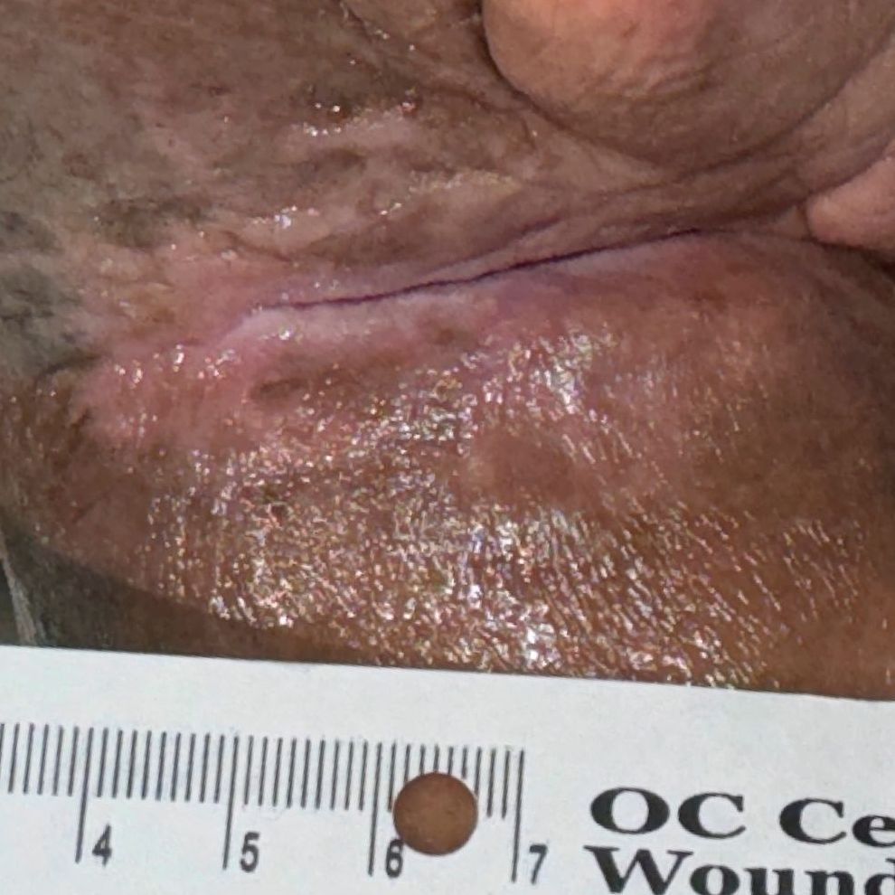 Wound Care for 3 x 3 mm Top of Leg Wound - After