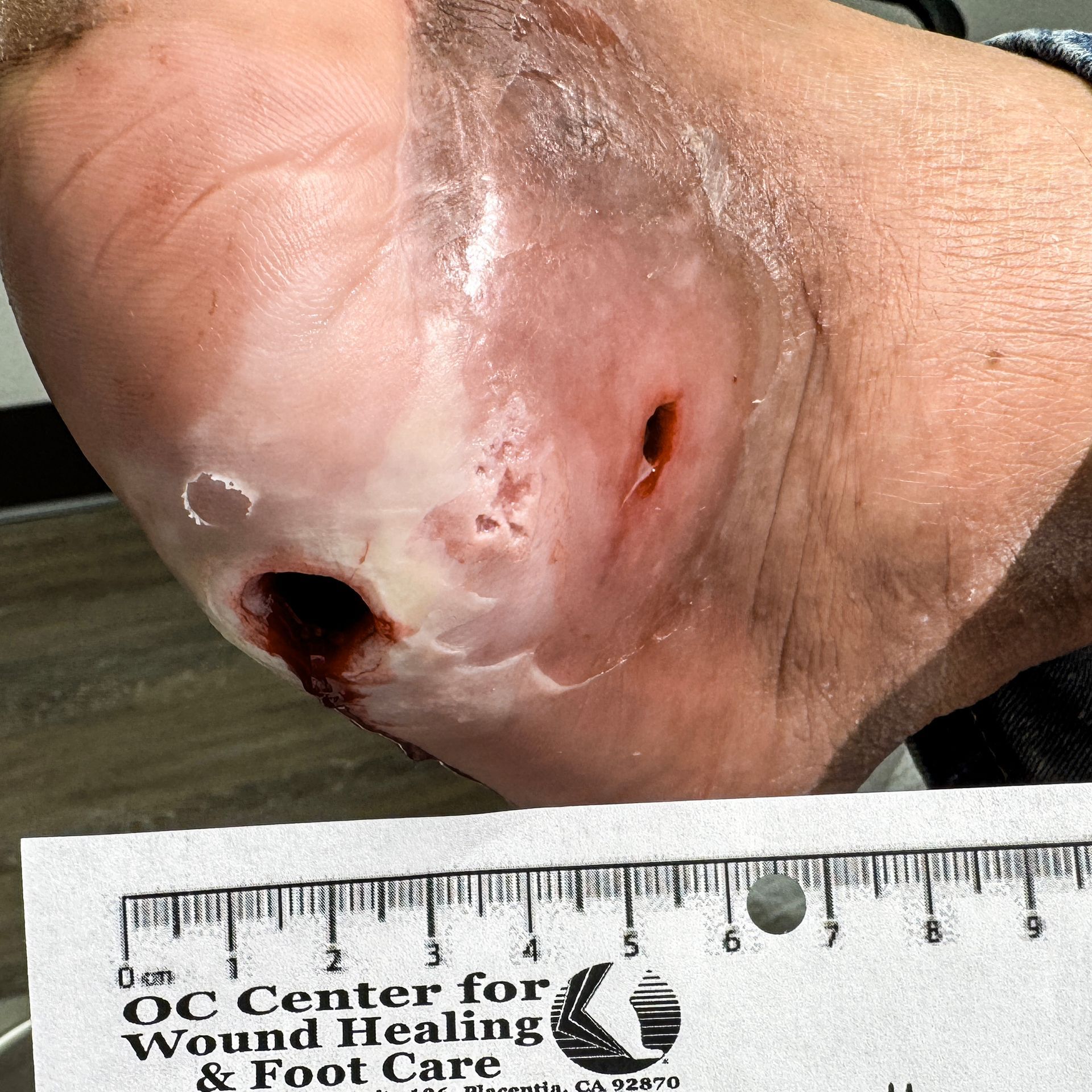 Wound Care for 3 x 3 mm Top of Leg Wound - Before