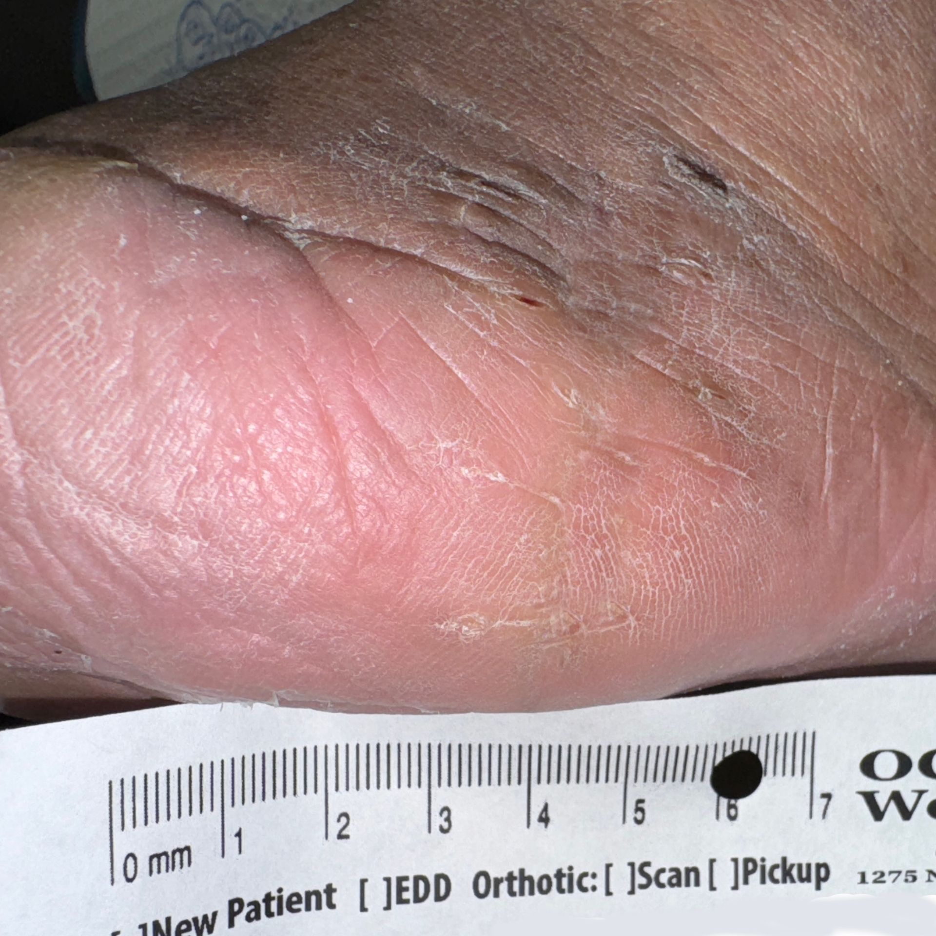Wound Care for 3 x 3 mm Top of Leg Wound - After
