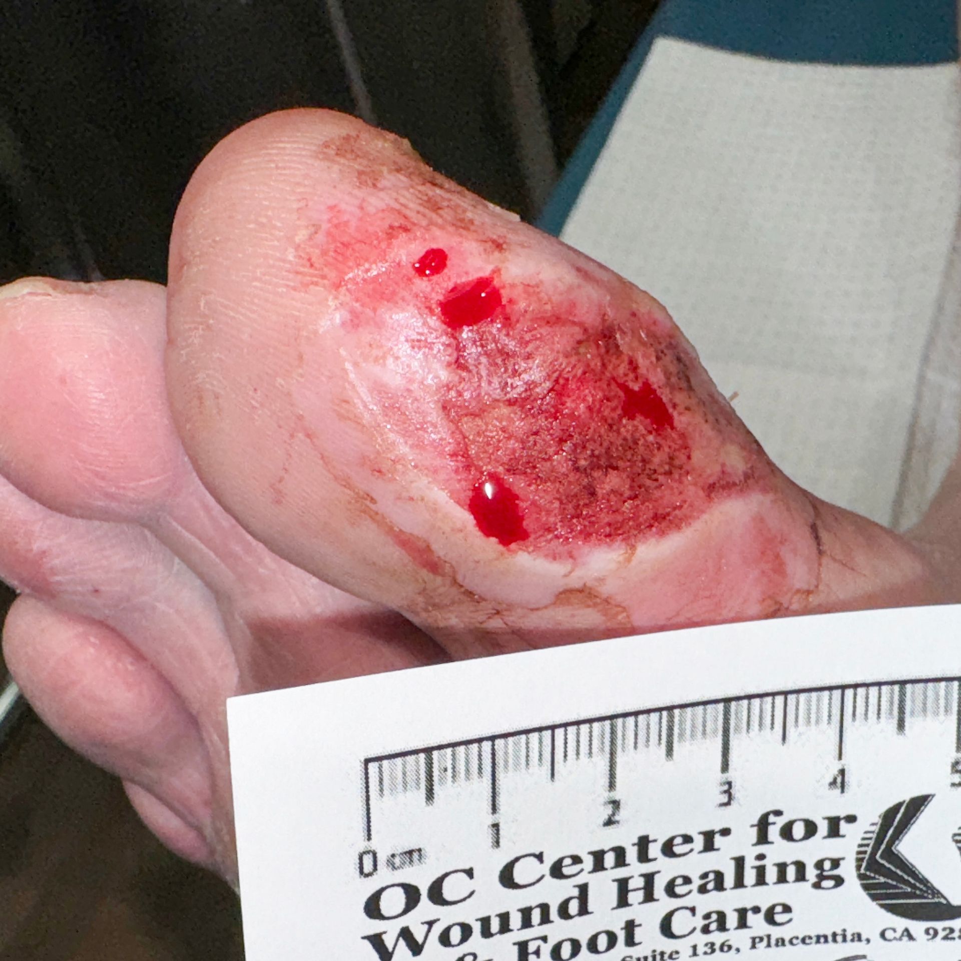 Wound Care for 3 x 3 mm Top of Leg Wound - Before