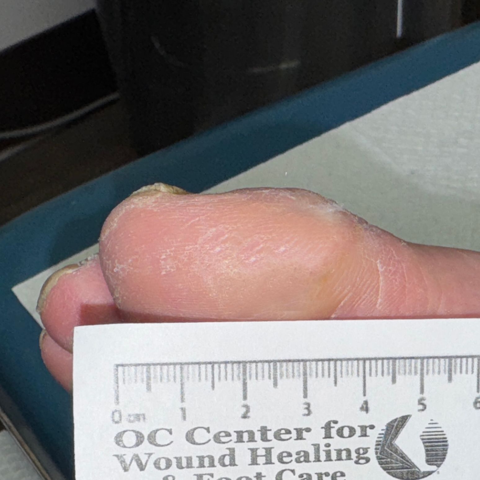 Wound Care for 3 x 3 mm Top of Leg Wound - After