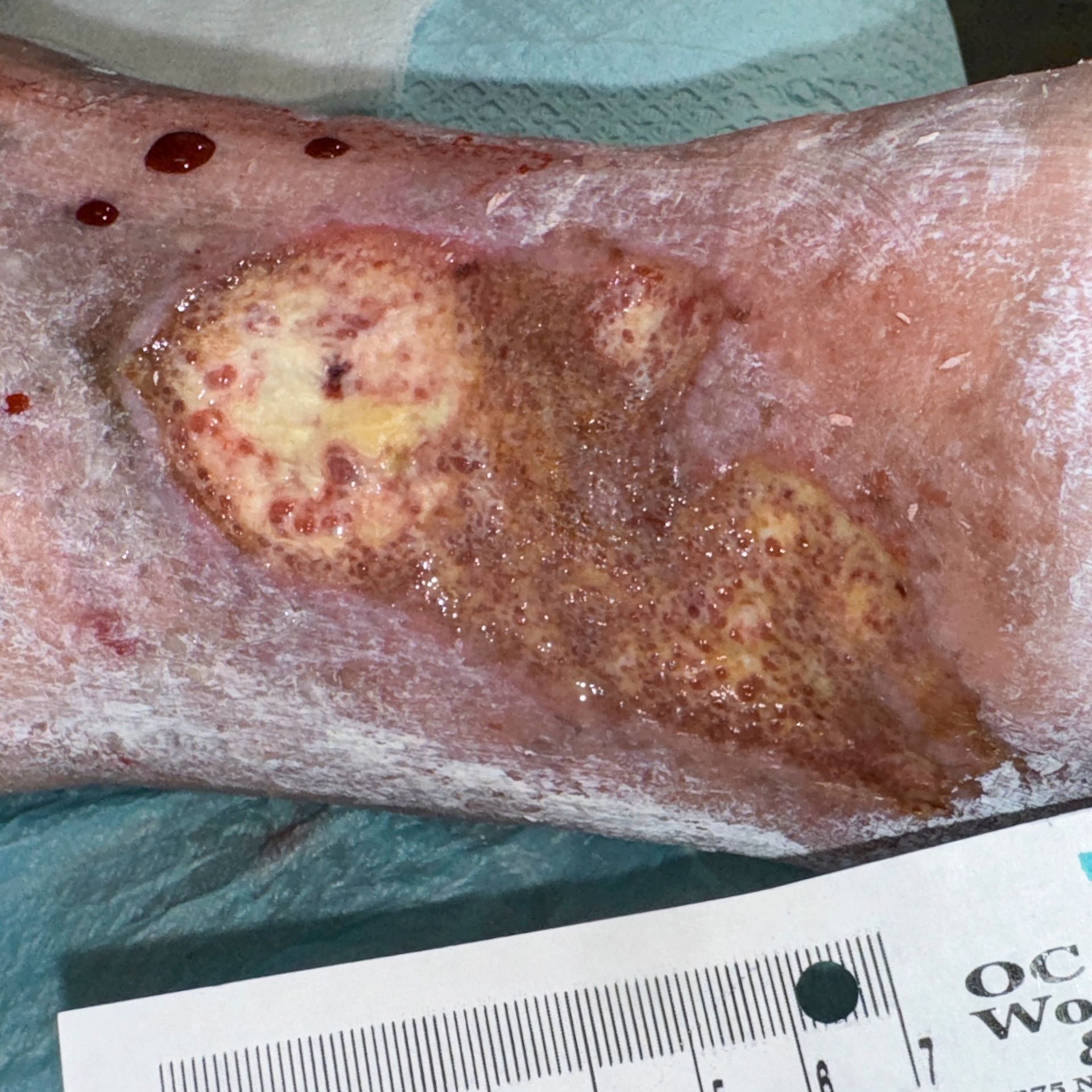 Wound Care for 7 x 6 cm Significant Leg Wound - Before