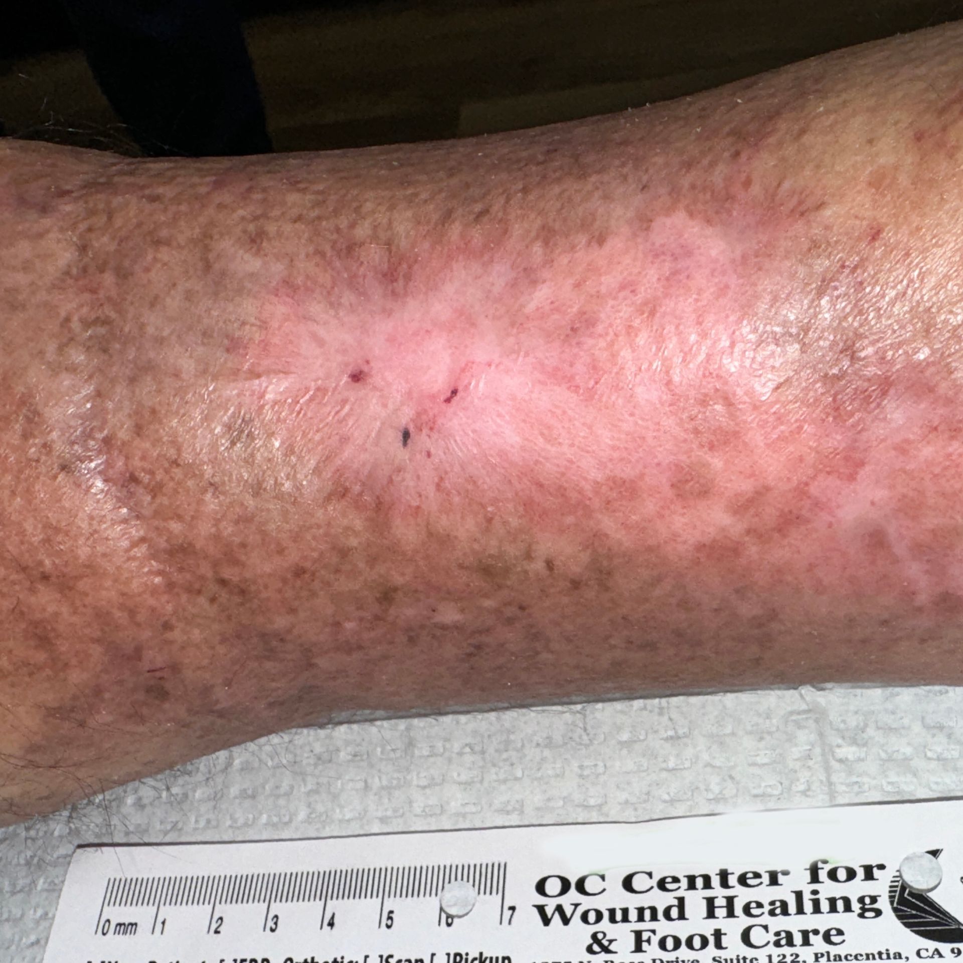 Wound Care for 7 x 6 cm Significant Leg Wound - After