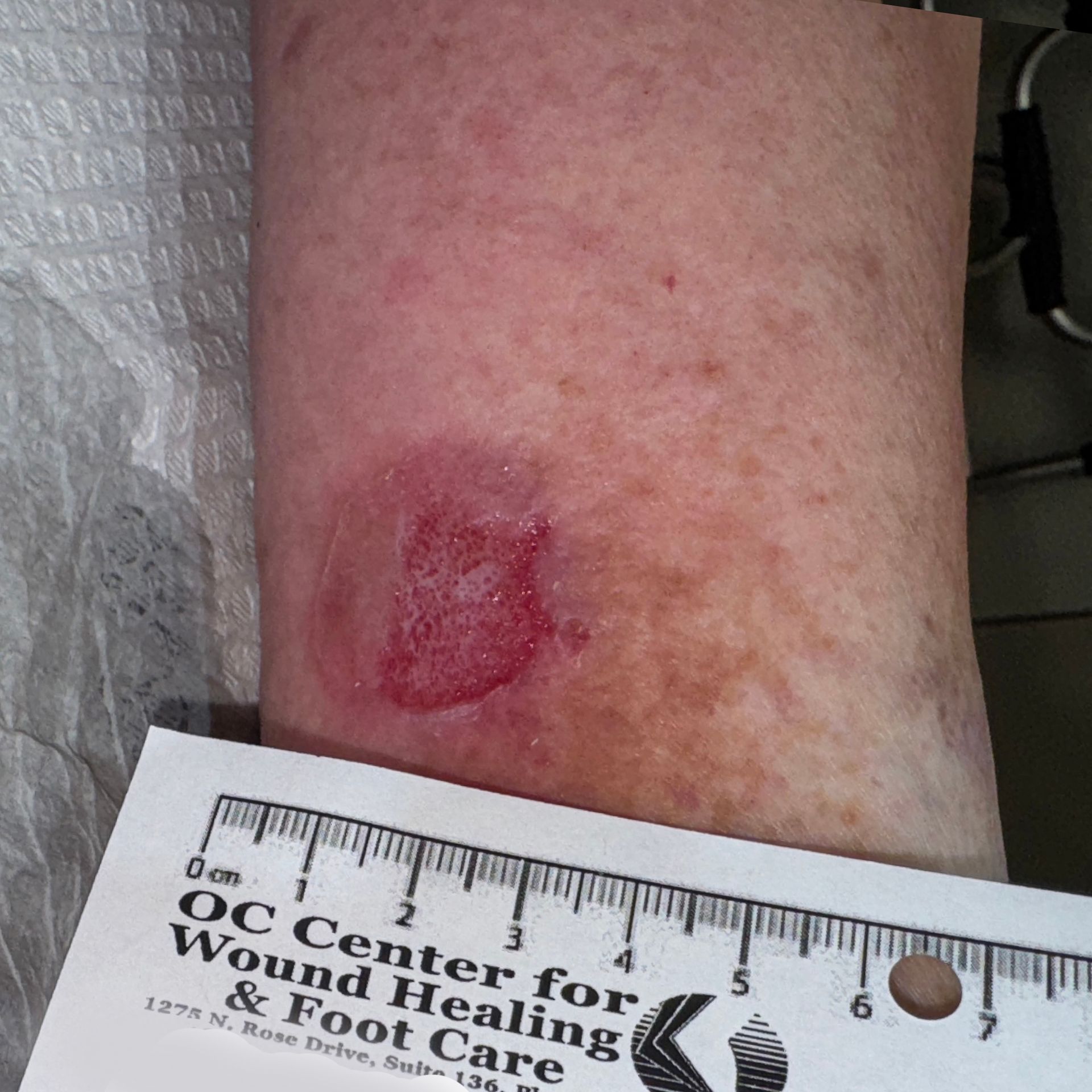 Wound Care for 2 x 2 CM Leg Wound - Before