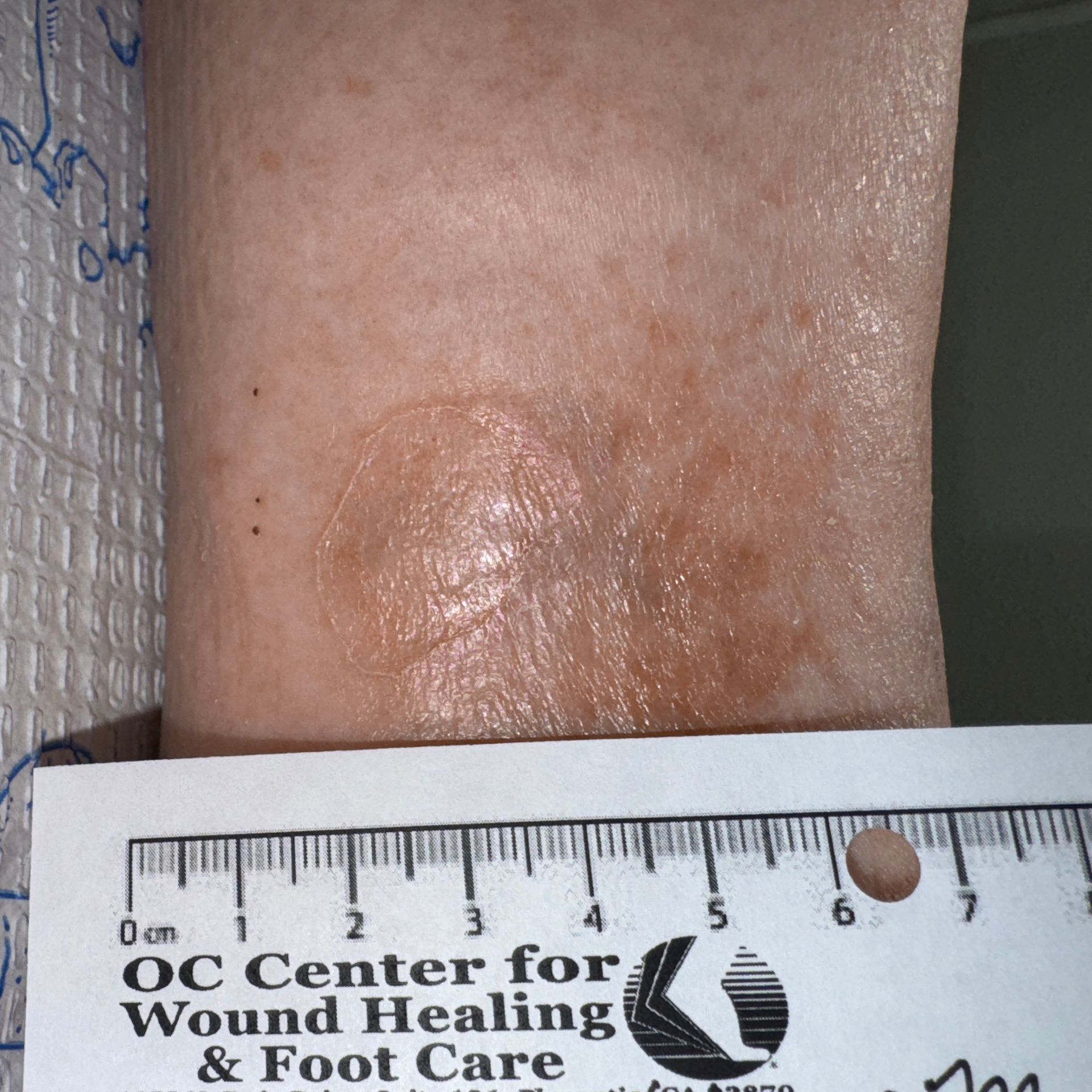 Wound Care for 2 x 2 CM Leg Wound - After