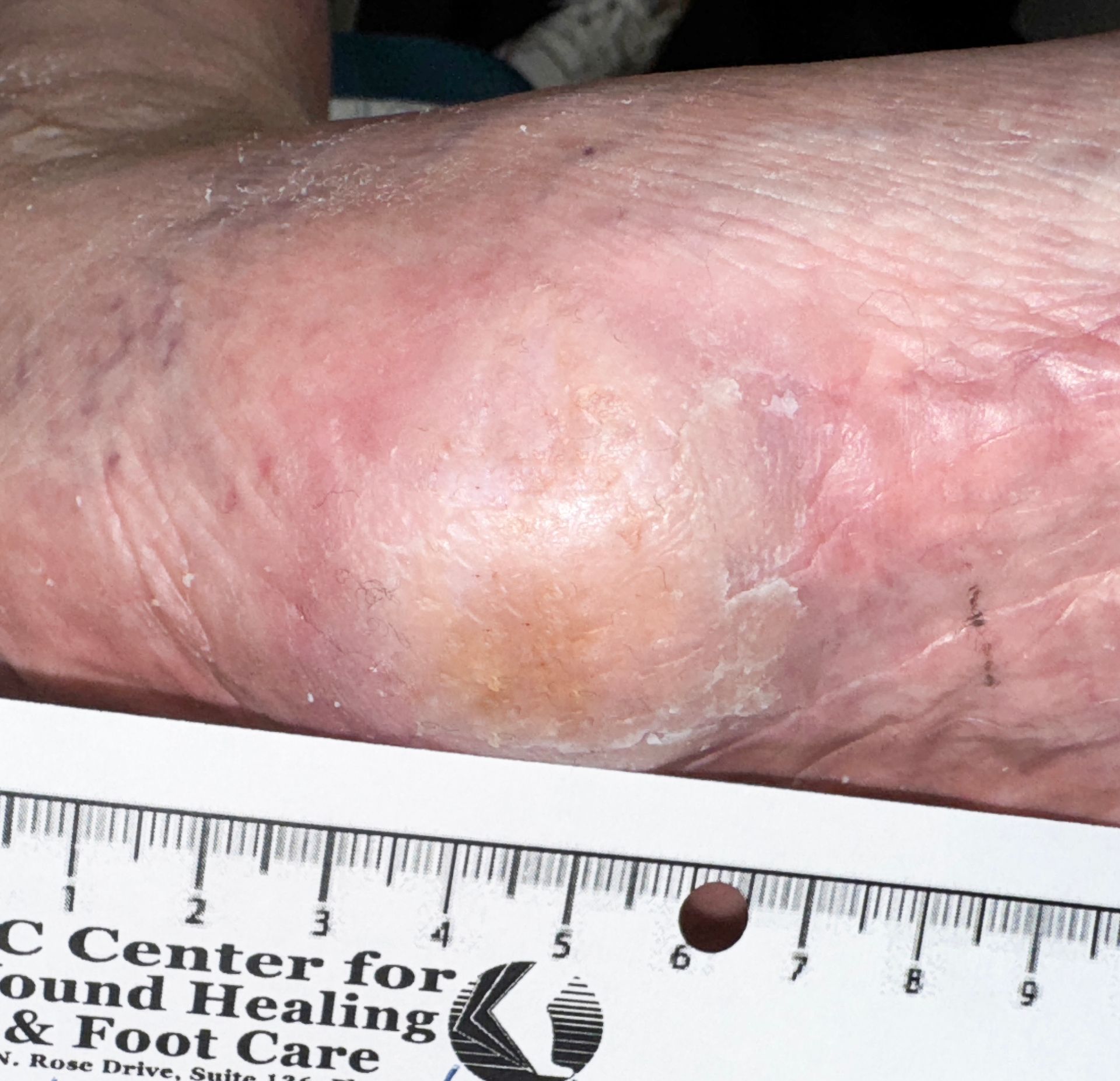 Wound Care for 3 x 3 cm Black Spot on Foot Arch Wound - After