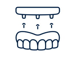 Dental implant diagram showing upper and lower teeth with arrows indicating attachment