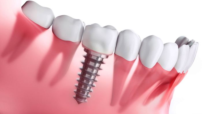 Dental implant anchored in pink gums beneath white teeth, shown in a close-up medical illustration.