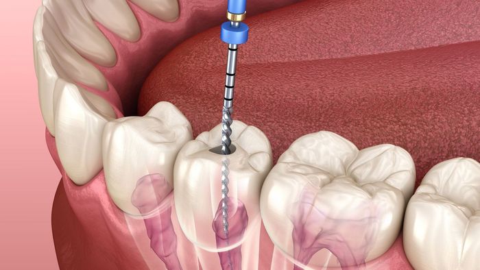 Dental drill cutting a tooth during a root canal procedure