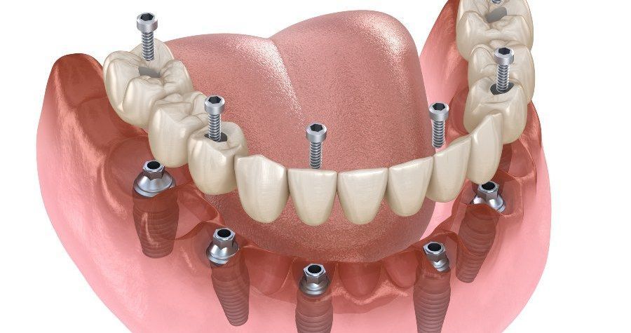 3D dental model showing upper and lower dentures on implants with pink gum tissue