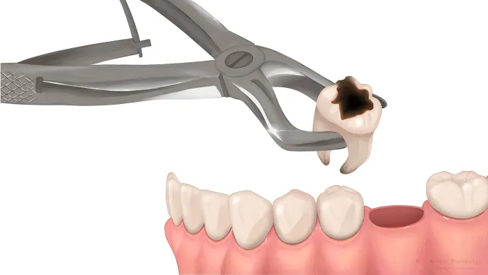 Dental forceps extracting a tooth from a gum-lined jaw model