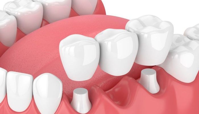 Close-up 3D illustration of white teeth and pink gums with a raised gum flap exposing a tooth implant