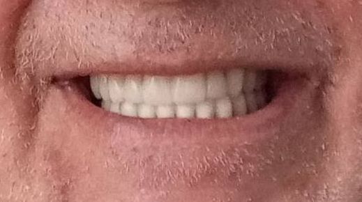 Close-up of a smiling mouth with visible teeth and light pink lips