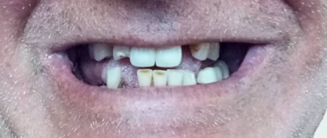 Close-up of a smiling mouth with missing front teeth and visible lips