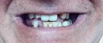 Close-up of a smiling mouth with missing front teeth and visible lips