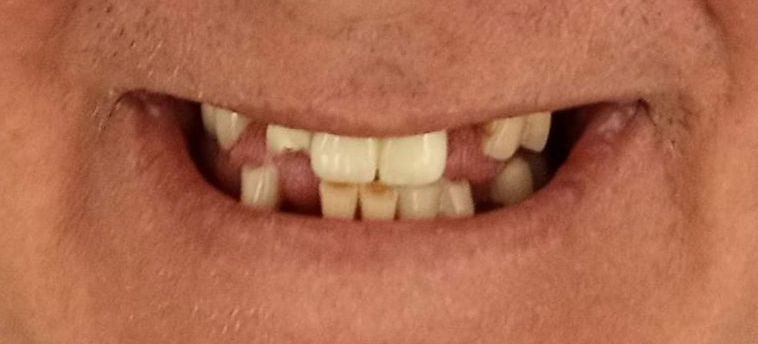 Close-up of a smiling mouth with two missing front teeth and visible front teeth and gums