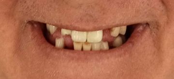 Close-up of a smiling mouth with two missing front teeth and visible front teeth and gums
