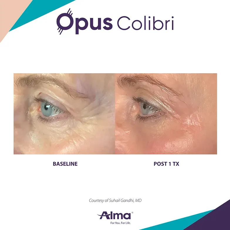 A before and after photo of a woman 's eye.