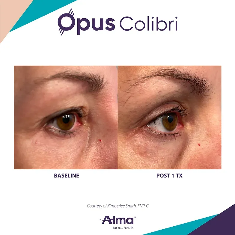 A before and after picture of a woman 's eyes