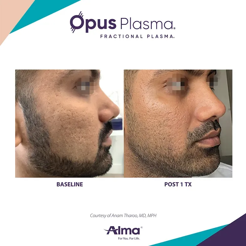 A man with a beard is shown before and after using opus plasma