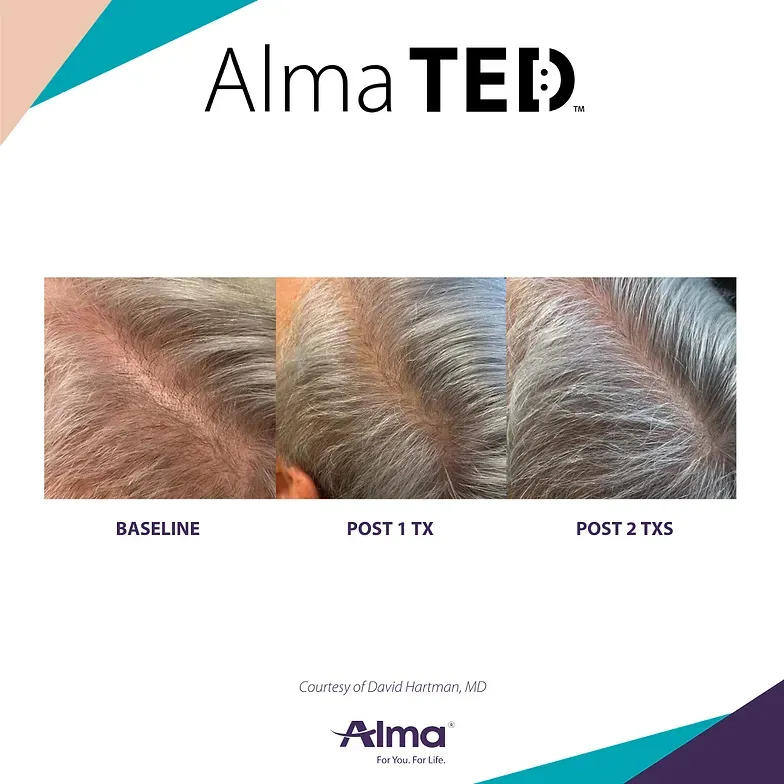 Three pictures of a man 's head showing a baseline , post 1 tx , and post 2 txs.