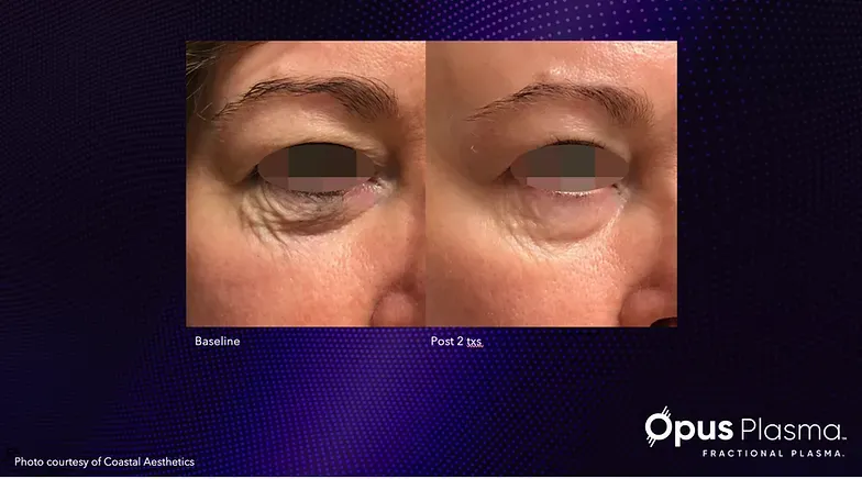 A before and after picture of a woman 's eye.