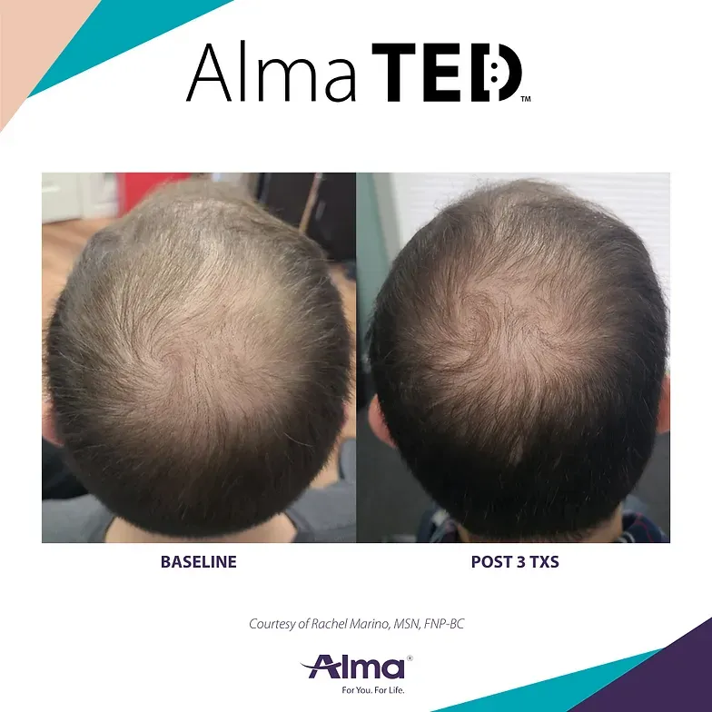 A before and after photo of a man 's head with alma ted written on the bottom