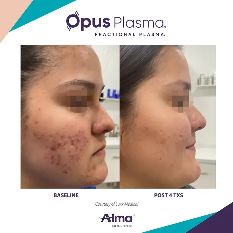 A before and after photo of a woman 's face with acne