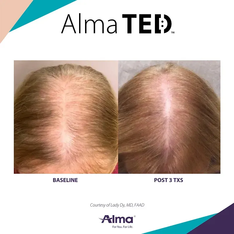 A picture of a woman 's hair before and after alma ted treatment