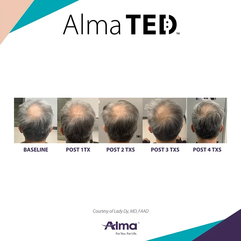 A picture of a man 's head with the words alma ted on it