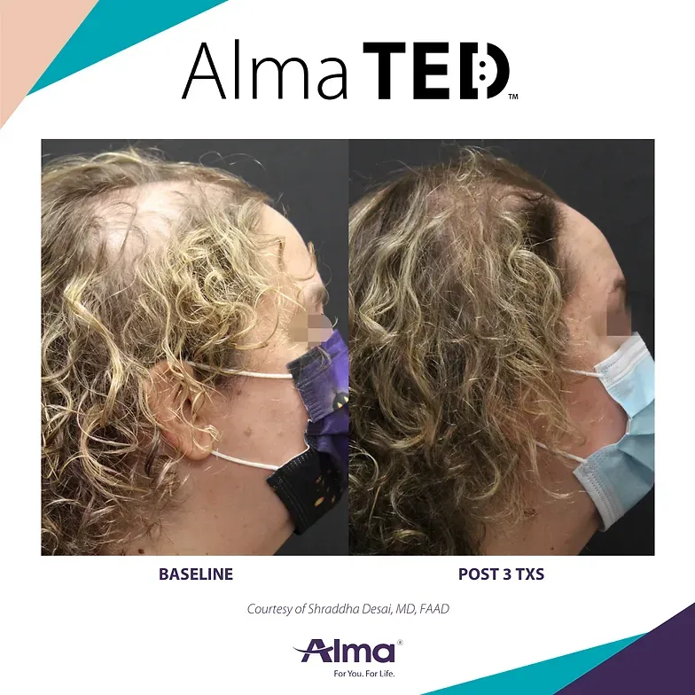A before and after photo of a woman wearing a mask