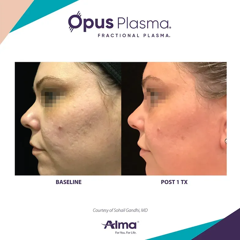 A woman 's face is shown before and after a fractional plasma treatment.